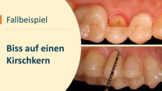 https://zahnrettung-hamburg.de/wp-content/uploads/2023/08/Fall3-klein-tiny-320x180.jpg